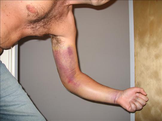 Post-op bruising